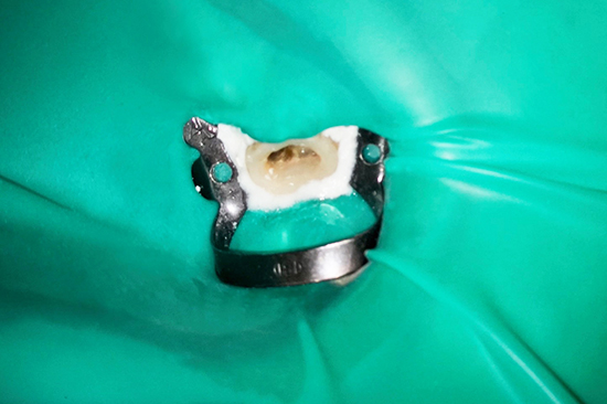 ラバーダム防湿